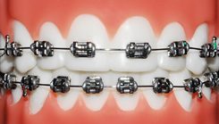 silver-metal-braces